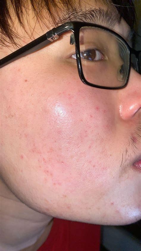 Acne breakouts/acne scars, uneven texture, dryness and flakiness