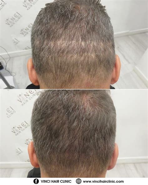 hair transplant scar repair - Cinda Bonner