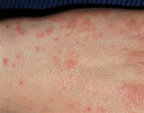 atypical scabies symptoms unusual signs  mites  doctors dont