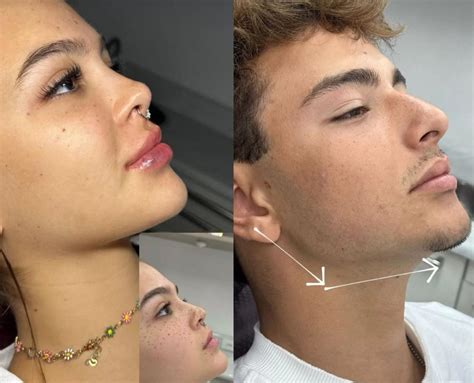 Perfiloplastia O Que É - O que é perfiloplastia? Conjunto de técnicas promete harmonizar o ...