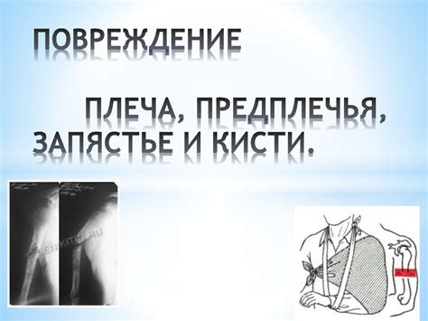Повреждение плеча, предплечья, запястья и кисти - презентация онлайн
