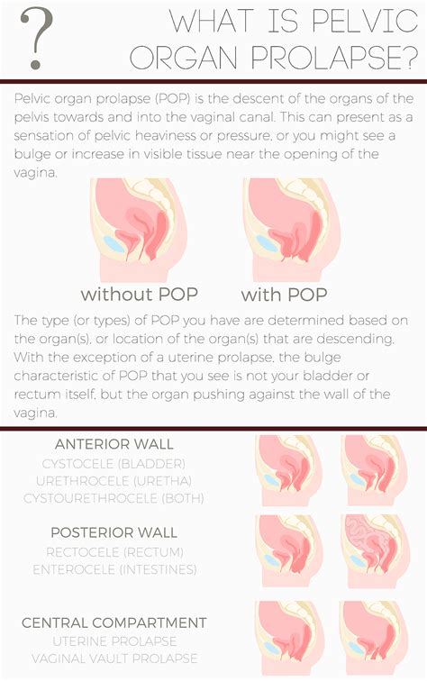 Menstrual Cup And Pelvic Organ Prolapse at Alexis Hoff blog