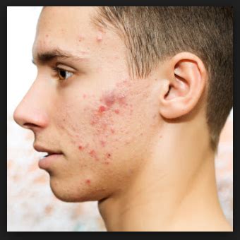 Jawline Acne Causes and Treatment - Home