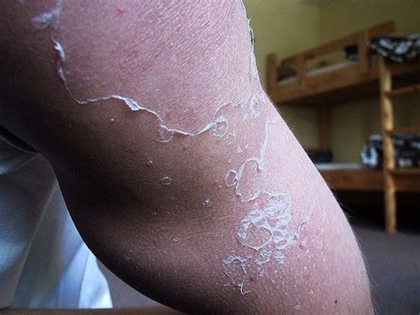 Лучшие средства от ожогов в 2025 году. Виды ожогов, лечение, профилактика.