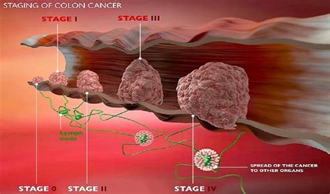 In the treatment of colon cancer - Arabic Herbal Medicine