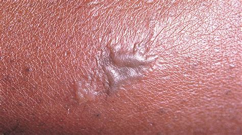Herpes Rash Scrotum