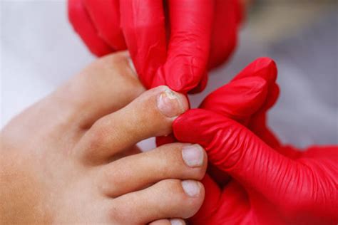 onycholysis  stock  pictures royalty  images