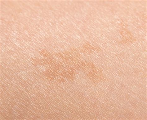 types  birthmarks birthmark removal overview cost