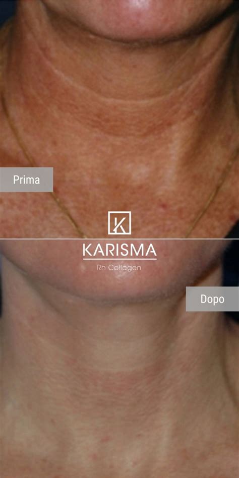 KARISMA - Softfiller biorestitutivo | Rh Collagen