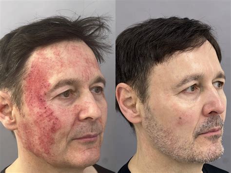 laser treatments  skin cancer