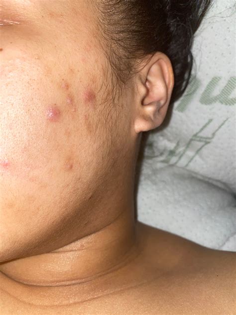 Acne problems :( - Beauty Insider Community