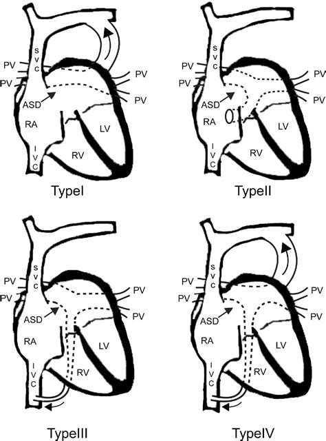 Total Anomalous Pulmonary Venous Connection: From Embryology to a