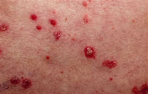 Guttate Psoriasis | Symptoms, Causes, Treatment, Diagnosis – Barphani