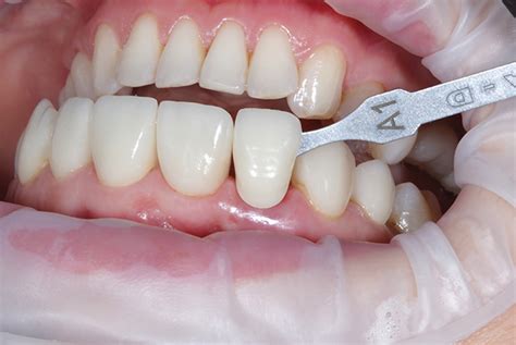 emax veneers cost uk emax porcelain veneers