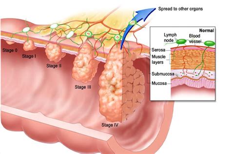 rectal warts