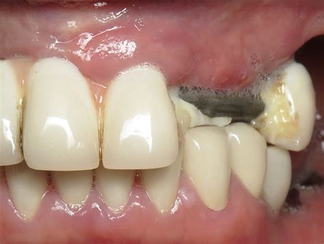 How to Avoid Common Problems with Dental Bridges - NoFrills Dental