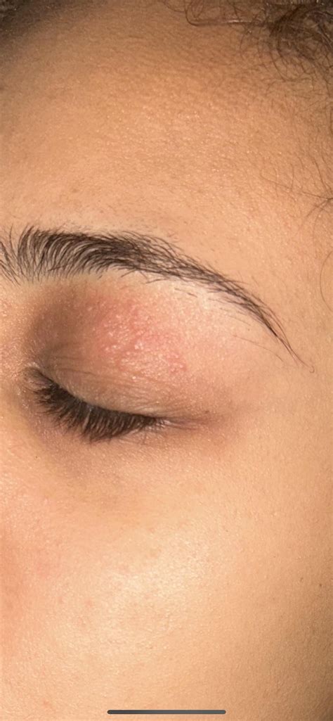 Small rash on eyelid : r/skin