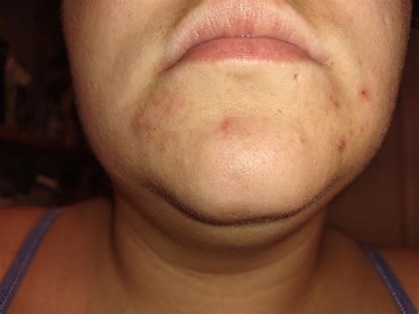 Hard lumps? : r/Staphacne