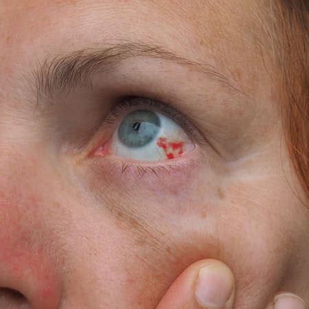 Photo of Subconjunctival hemorrhage or - ID:175361725 - Royalty Free ...