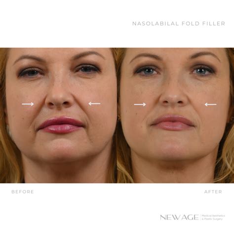 nasolabial fold  age aesthetics
