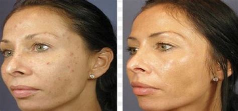 rid  leftover acne marks joybynaturecom