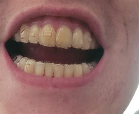 Not tracking?? : r/Invisalign