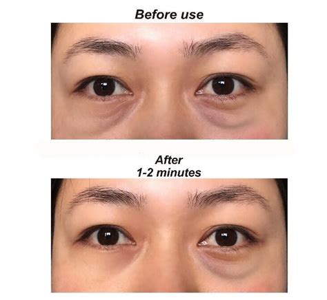 Tired of looking tired? Our under eye bag removal cream is specifically formulated to reduce the ...