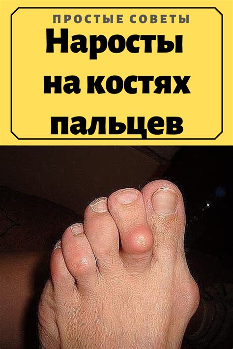 На суставе пальца руки появился нарост фото