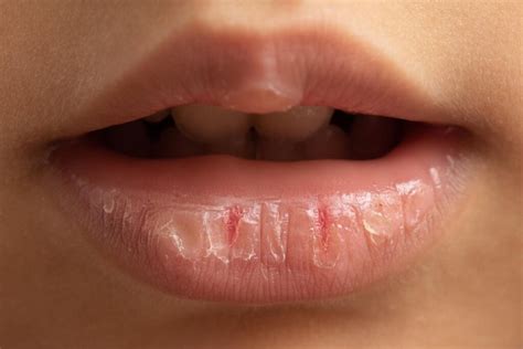 Labios Queimando E Ardendo