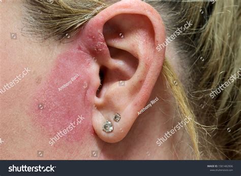 Caucasian Woman Red Itchy Rash On Stock Photo 1581482806 | Shutterstock
