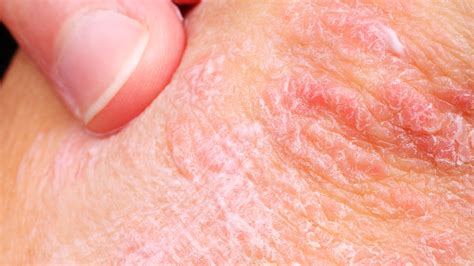 Bumps On Elbows Causes Of Itchy Non Itchy Bumps Treat - vrogue.co