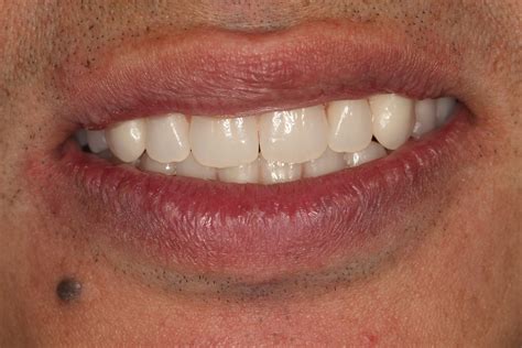 Upper and lower All-on-Four permanent ceramic fixed bridges using