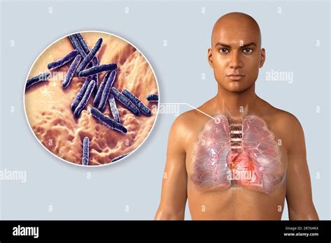 Secondary tuberculosis infection and close-up view of Mycobacterium ...