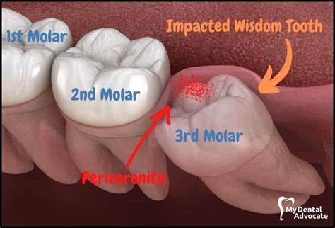 Impacted Wisdom Teeth: Symptoms, Causes, Removal & Recovery "Are you ...