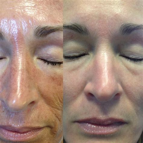 Elite Therapeutics Body and Skin Care: Jessner Peel
