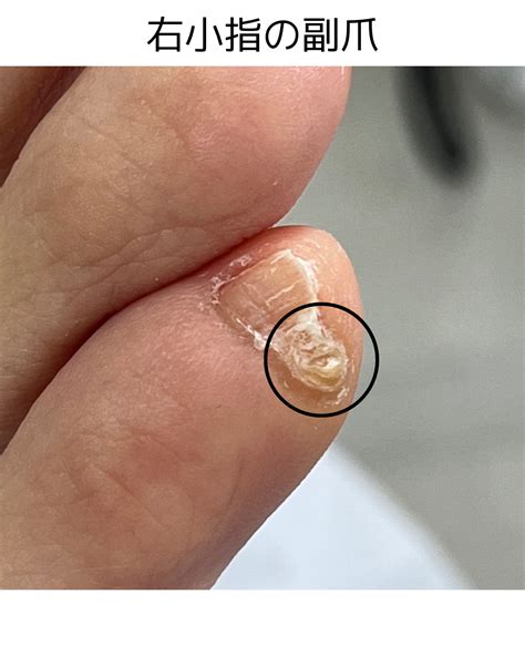 お客様のお手入れのご紹介☆セルフケアに限界を感じた小指の副爪(ふくそう) | 堺市 なかもず／ドイツ式フットケアサロン REFLERIA(リフレリア)