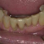 ; Lingual view of final esthetic result of the natural tooth pontic ...