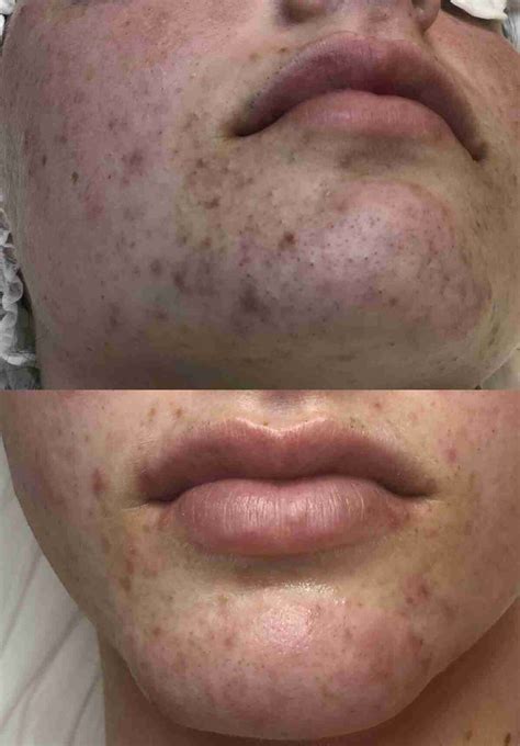 Unbelievable Blackhead Removal 2024: Before and After Pictures (Real People!) - az2dh9h