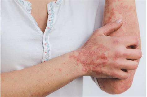 Psoriasis tied to higher risk for nonalcoholic fatty liver disease ...