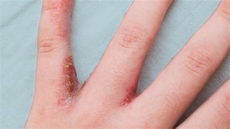 dyshidrotic eczema dyshidrosis symptoms