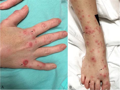 rat bite fever  symptoms  prevention