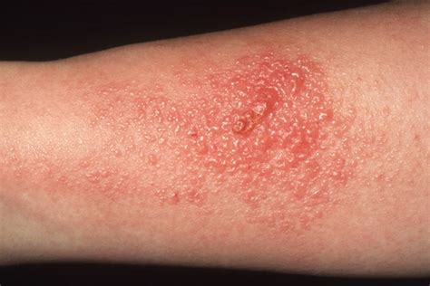 pictures   contagious skin rashes