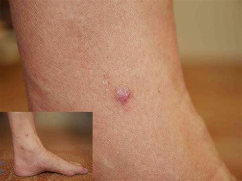 Common lumps and bumps on and under the skin: what are they?