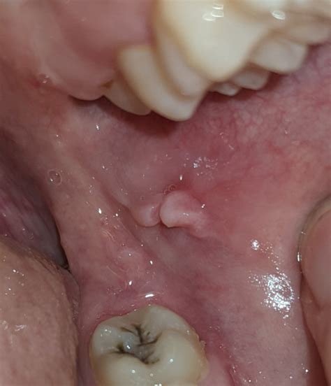 Lump in mouth, is it a concern? it's pretty sore, but I commonly bite ...