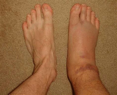 Can Swollen Legs & Feet Leave Feet Bruised - Job Porn