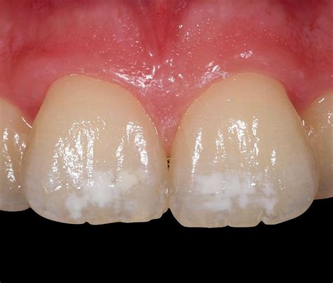 Mancha Branca No Dente O Que É - PREVENÇÃO: Manchas brancas nos dentes | Directorio Odontológico