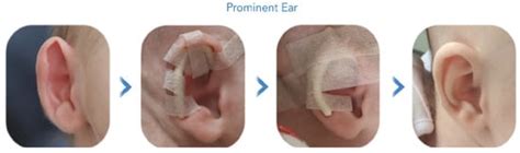 Modern Applications of 3D Printing: The Case of an Artificial Ear ...