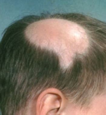 Alopecia Areata - Alopecia Areata Auf Bart Stockfoto Und Mehr Bilder ...