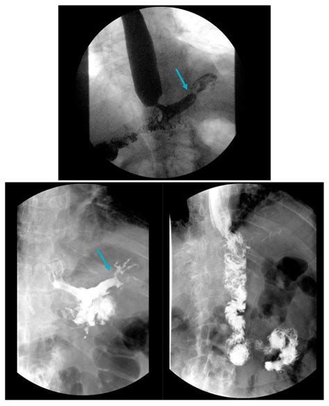 Gastroesophageal Reflux Disease in Obesity: Bariatric Surgery as Both