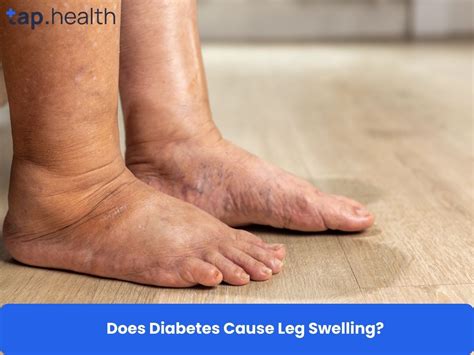 Does Diabetes Cause Leg Swelling? The Warning Signs You Must Know - Tap ...